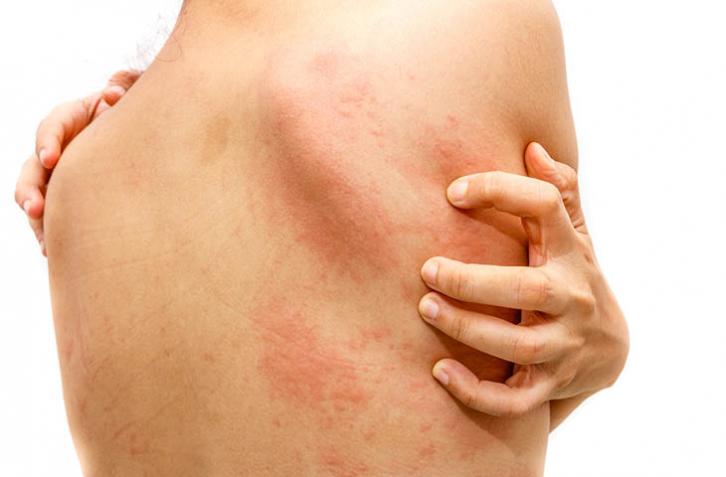 Dermatitis y alergia